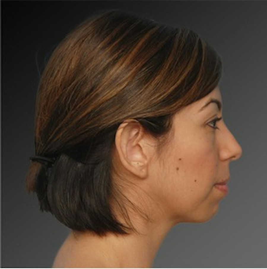 Patient 106038110 | Profile View | Before | Chin Augmentation — Steven Teitelbaum MD -