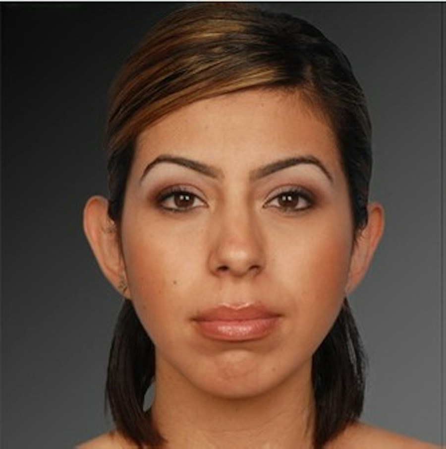 Patient 106038110 | Front View | After | Chin Augmentation — Steven Teitelbaum MD -
