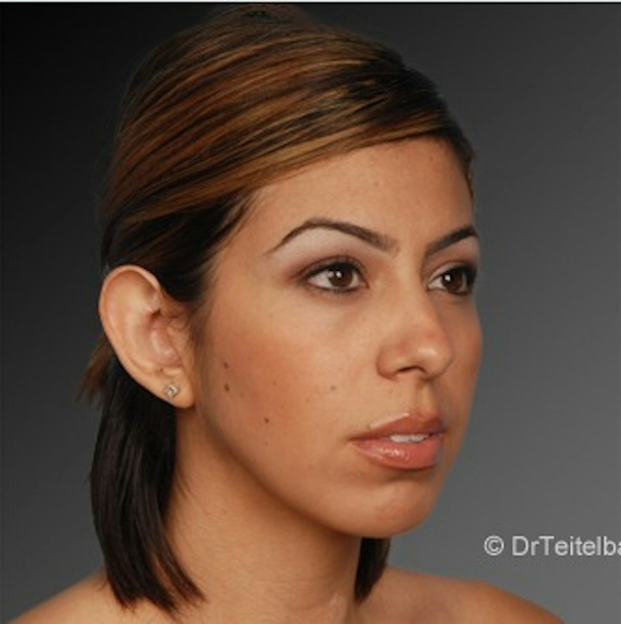 Patient 106038110 | Angle View | After | Chin Augmentation — Steven Teitelbaum MD -