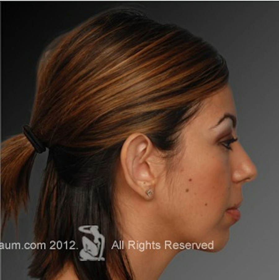 Patient 106038110 | Profile View | After | Chin Augmentation — Steven Teitelbaum MD -
