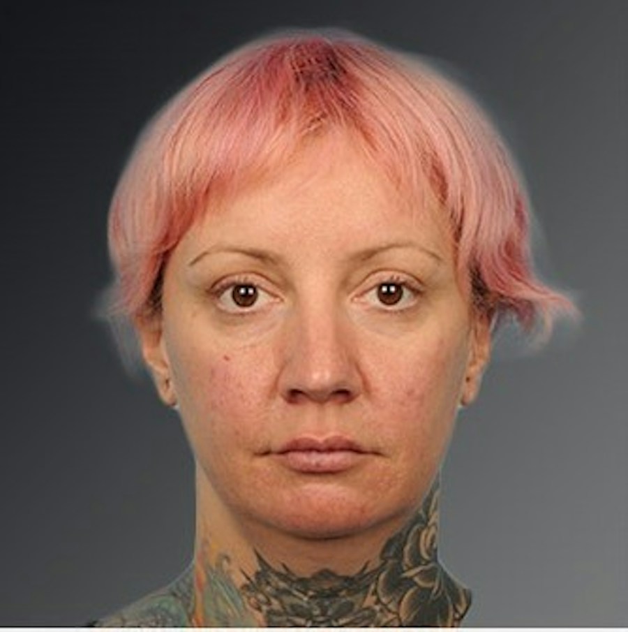 Patient 106038116 | Front View | Before | Chin Augmentation — Steven Teitelbaum MD -