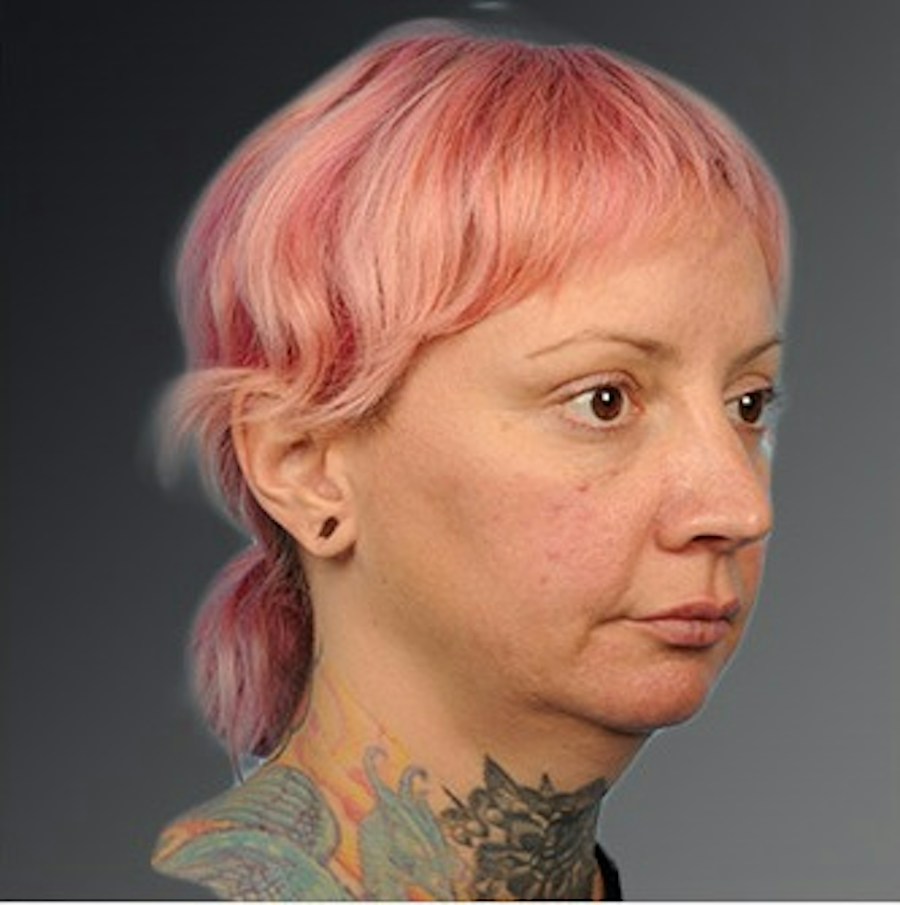 Patient 106038116 | Angle View | Before | Chin Augmentation — Steven Teitelbaum MD -