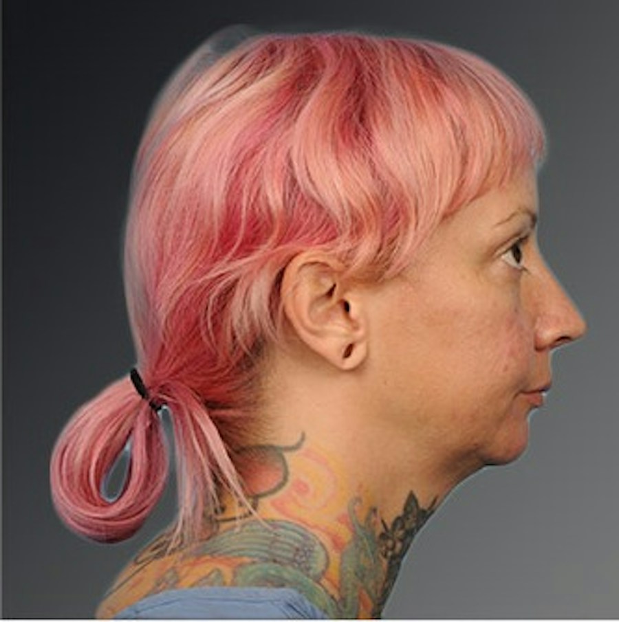 Patient 106038116 | Profile View | Before | Chin Augmentation — Steven Teitelbaum MD -