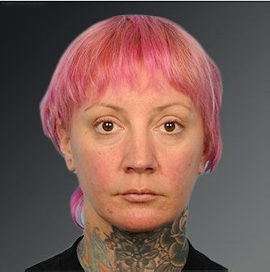 Patient 106038116 | Front View | After | Chin Augmentation — Steven Teitelbaum MD -
