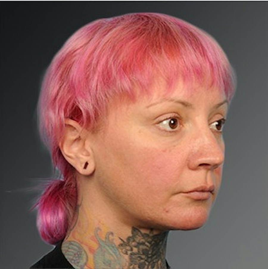 Patient 106038116 | Angle View | After | Chin Augmentation — Steven Teitelbaum MD -