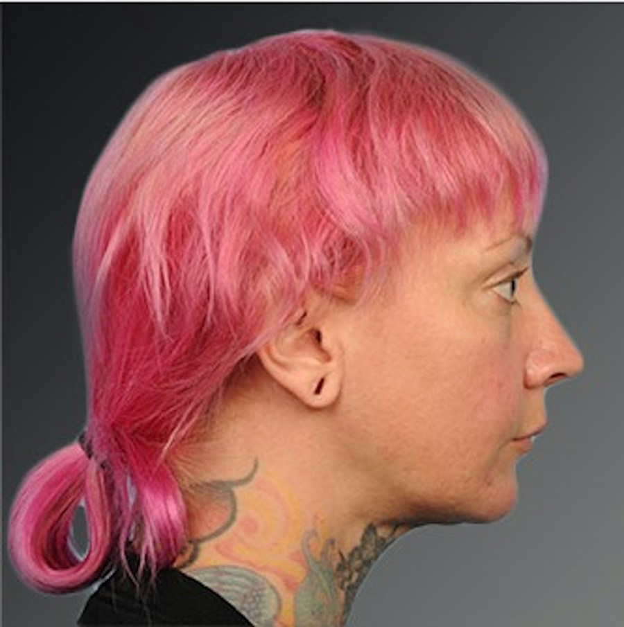 Patient 106038116 | Profile View | After | Chin Augmentation — Steven Teitelbaum MD -