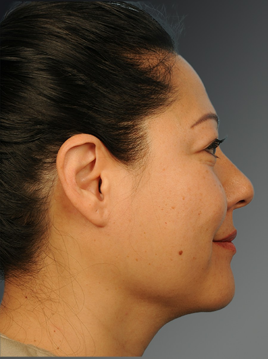 Patient 398712 | Profile View | After | Neck Liposuction — Steven Teitelbaum MD - Santa Monica
