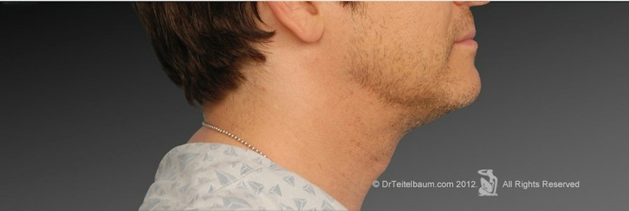 Patient 106041368 | Profile View | After | Neck Liposuction — Steven Teitelbaum MD - Santa Monica