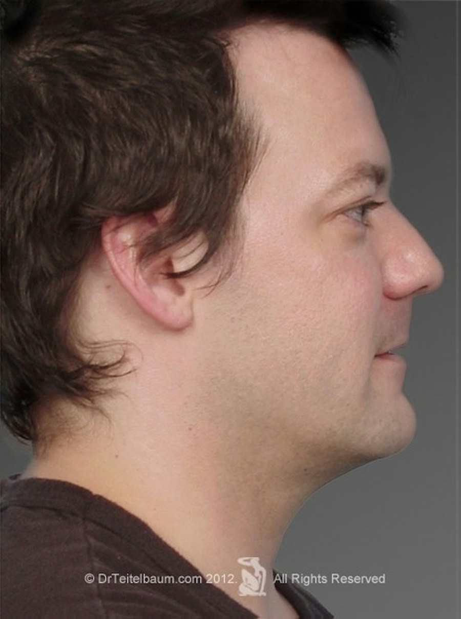 Patient 106041371 | Profile View | After | Neck Liposuction — Steven Teitelbaum MD - Santa Monica