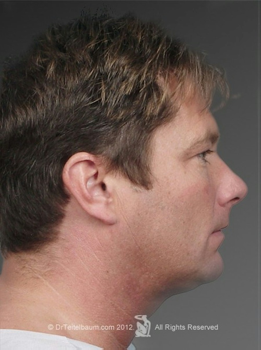 Patient 106041373 | Profile View | After | Neck Liposuction — Steven Teitelbaum MD - Santa Monica