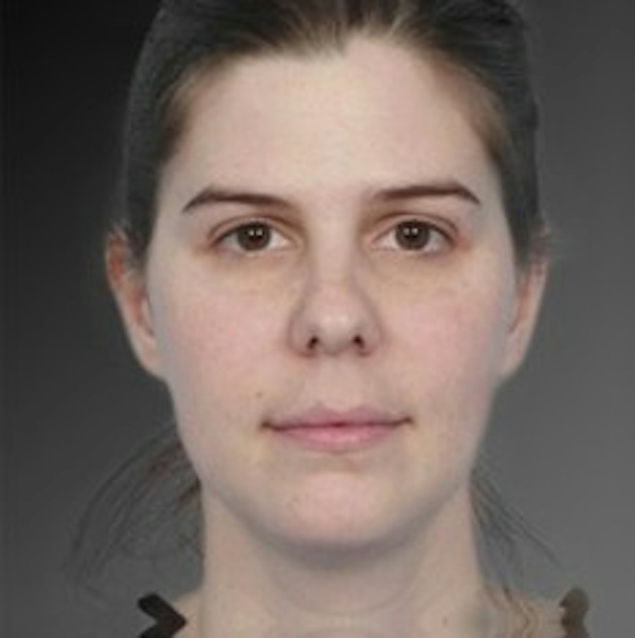 Patient 106041375 | Front View | Before | Neck Liposuction — Steven Teitelbaum MD -