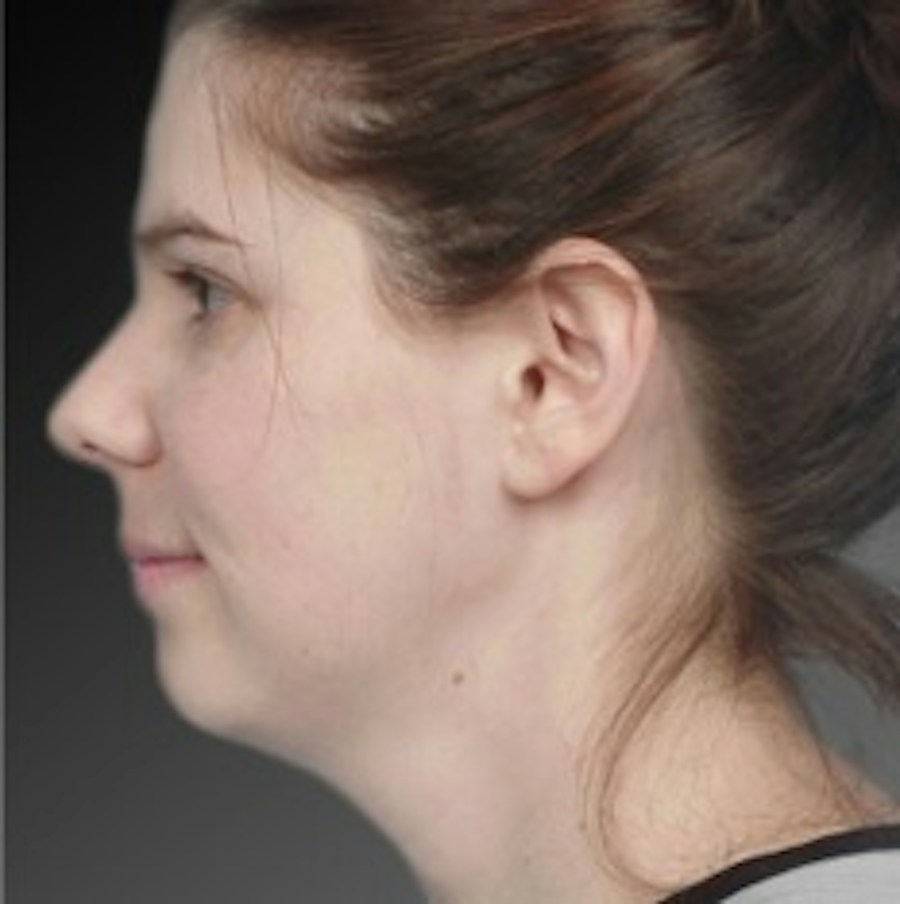 Patient 106041375 | Profile View | Before | Neck Liposuction — Steven Teitelbaum MD -