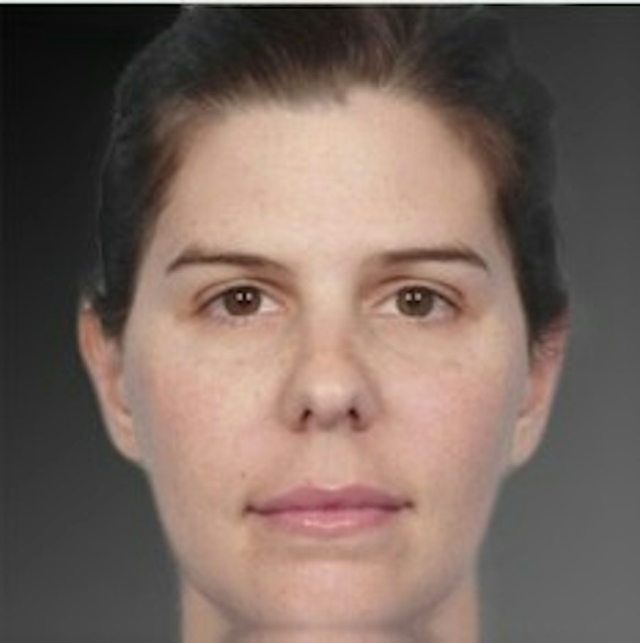 Patient 106041375 | Front View | After | Neck Liposuction — Steven Teitelbaum MD -