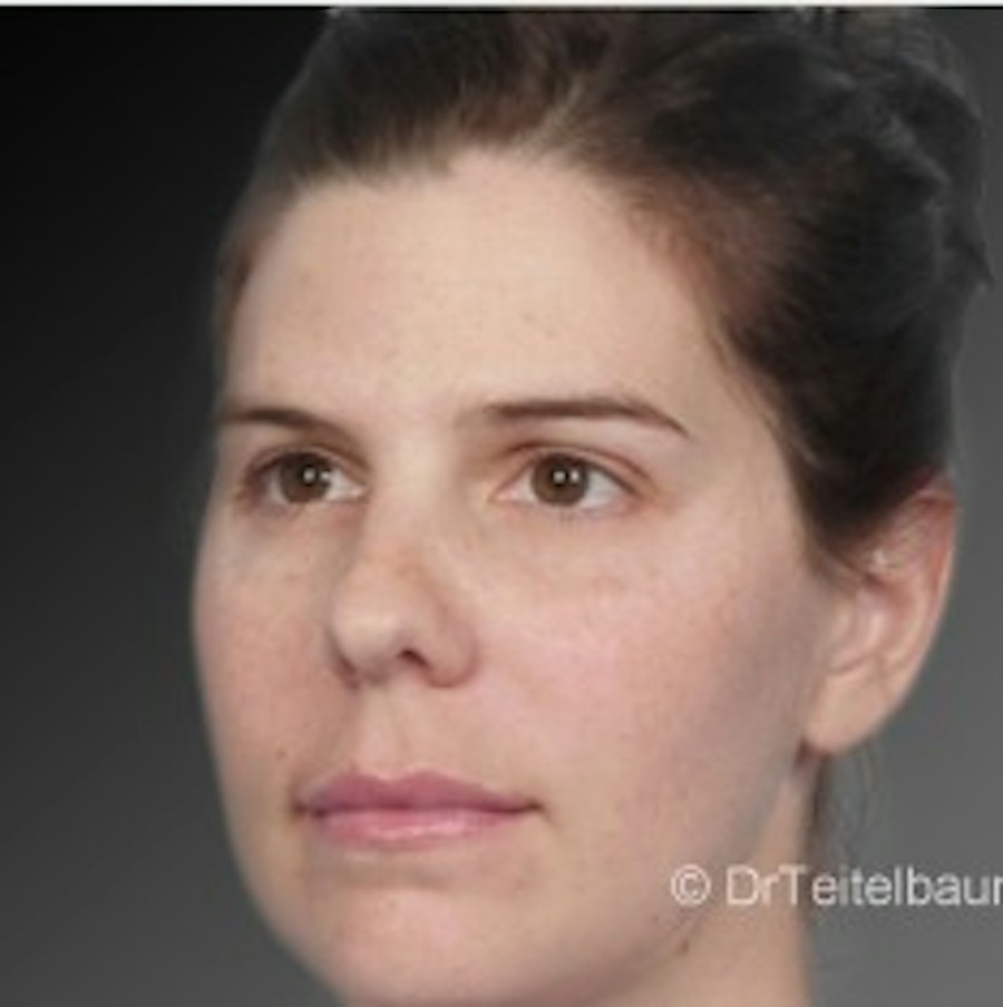 Patient 106041375 | Angle View | After | Neck Liposuction — Steven Teitelbaum MD -