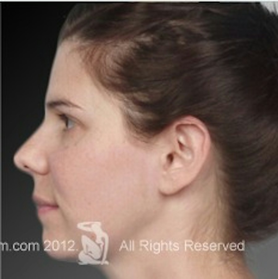 Patient 106041375 | Profile View | After | Neck Liposuction — Steven Teitelbaum MD -