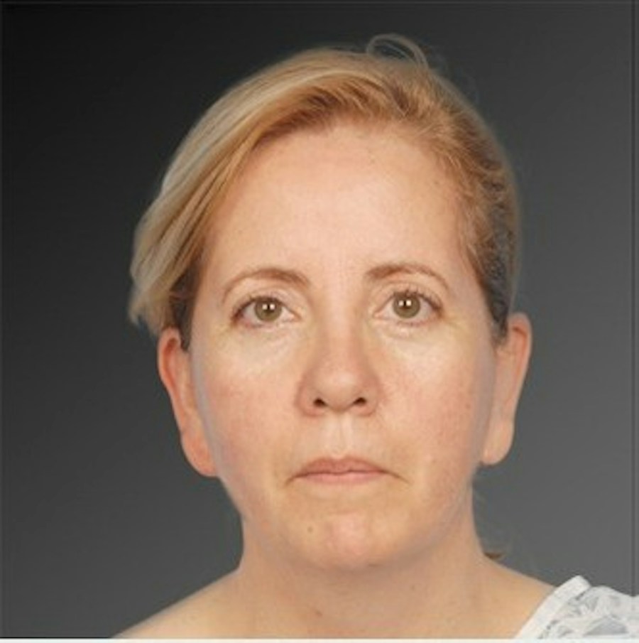 Patient 106041377 | Front View | Before | Neck Liposuction — Steven Teitelbaum MD -