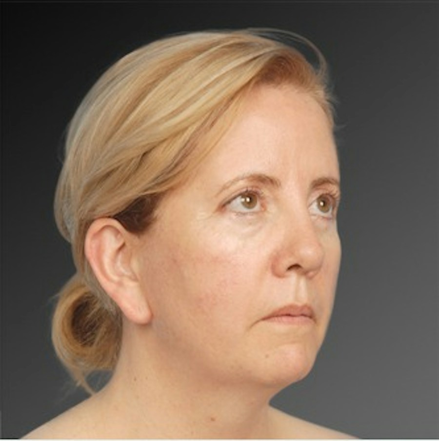 Patient 106041377 | Angle View | Before | Neck Liposuction — Steven Teitelbaum MD -