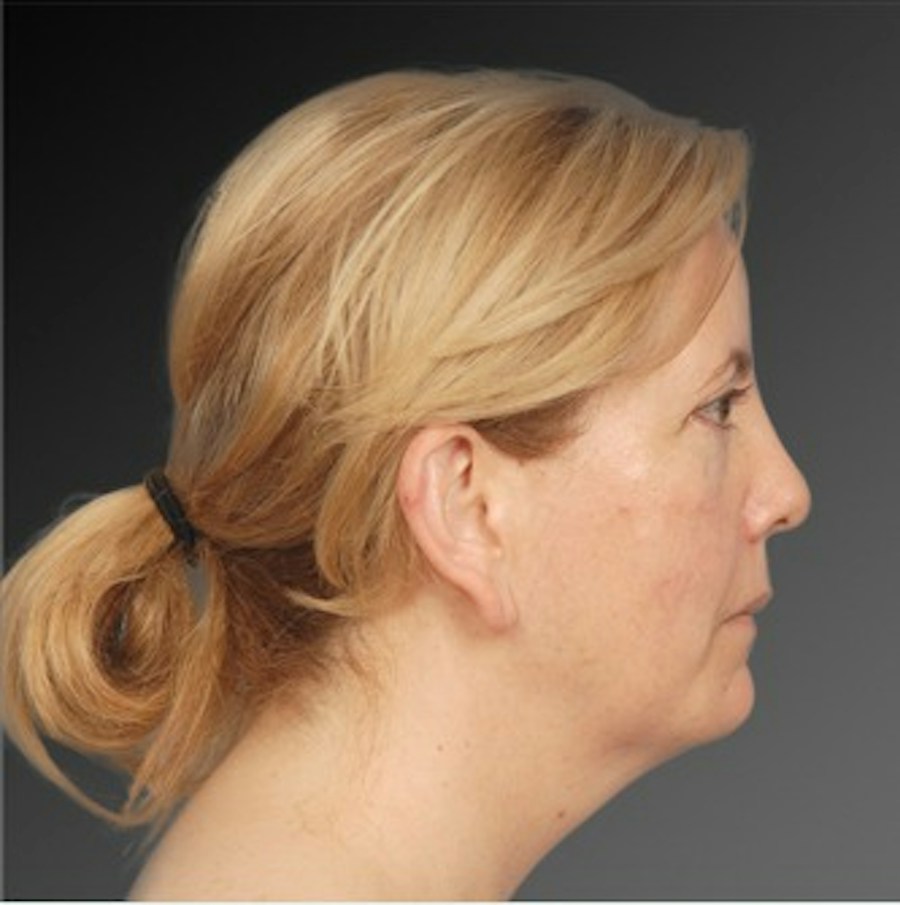 Patient 106041377 | Profile View | Before | Neck Liposuction — Steven Teitelbaum MD -