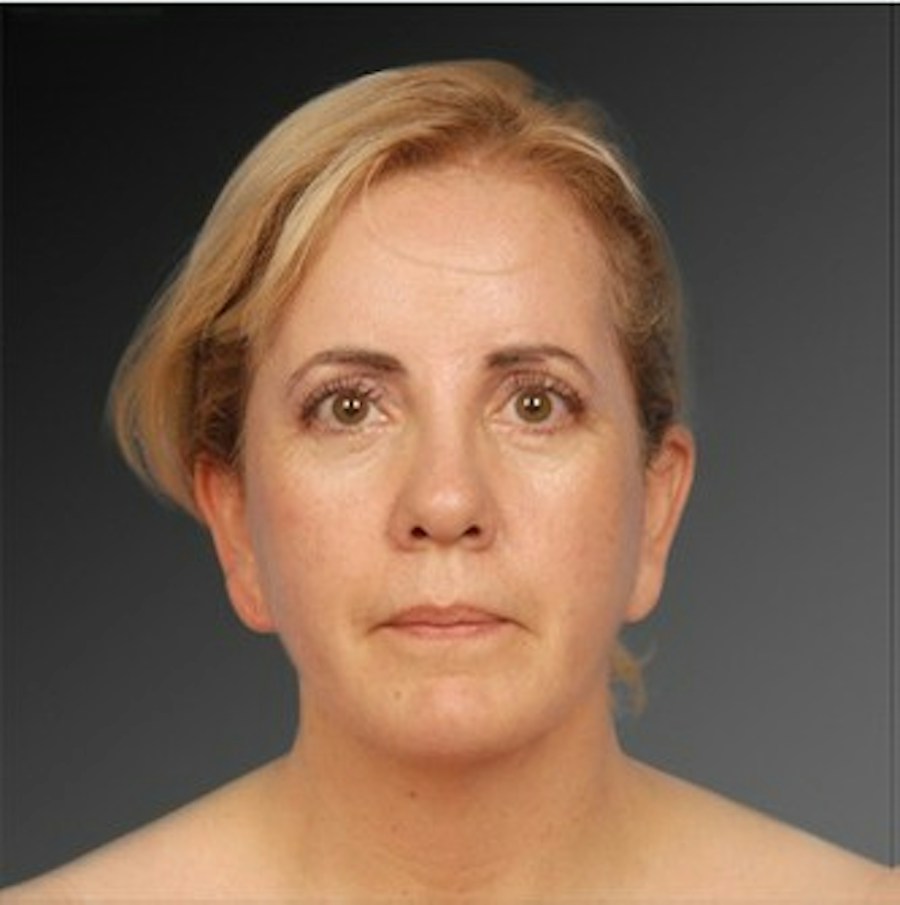 Patient 106041377 | Front View | After | Neck Liposuction — Steven Teitelbaum MD -