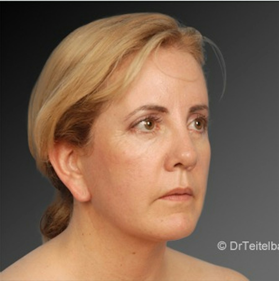 Patient 106041377 | Angle View | After | Neck Liposuction — Steven Teitelbaum MD -