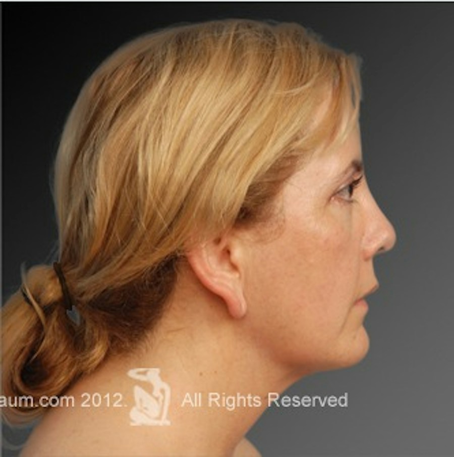 Patient 106041377 | Profile View | After | Neck Liposuction — Steven Teitelbaum MD -