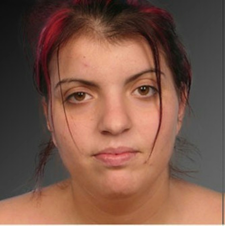Patient 106041379 | Front View | Before | Neck Liposuction — Steven Teitelbaum MD -