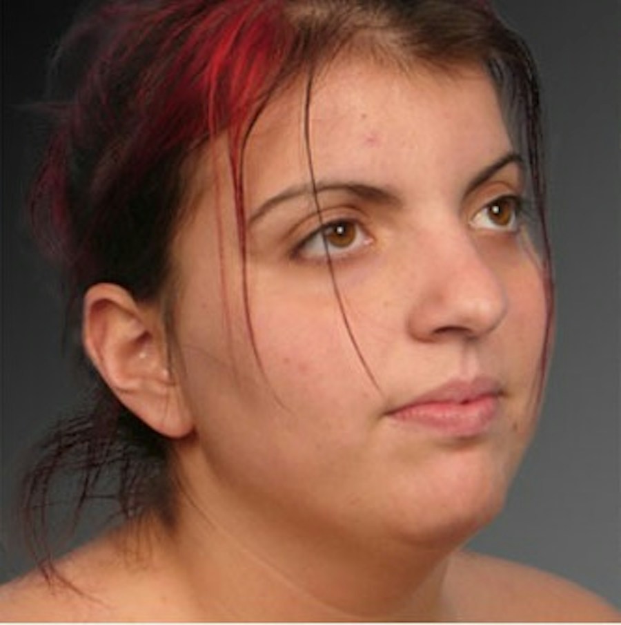 Patient 106041379 | Angle View | Before | Neck Liposuction — Steven Teitelbaum MD -