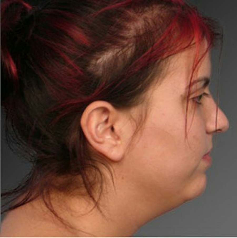 Patient 106041379 | Profile View | Before | Neck Liposuction — Steven Teitelbaum MD -