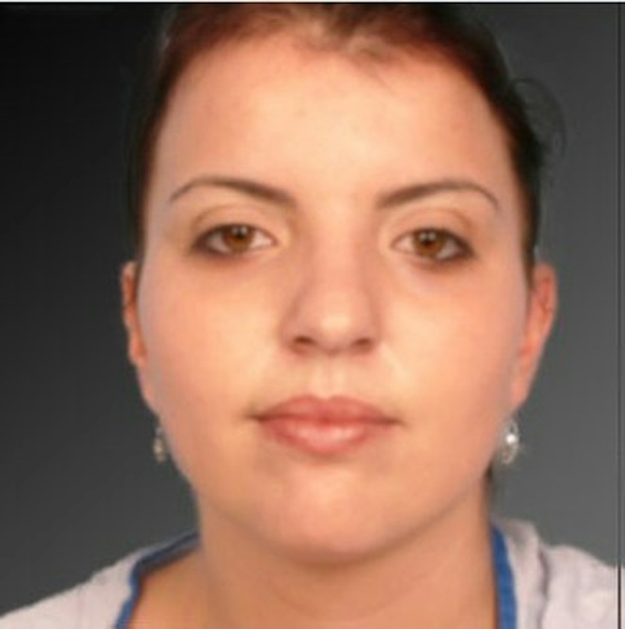 Patient 106041379 | Front View | After | Neck Liposuction — Steven Teitelbaum MD -