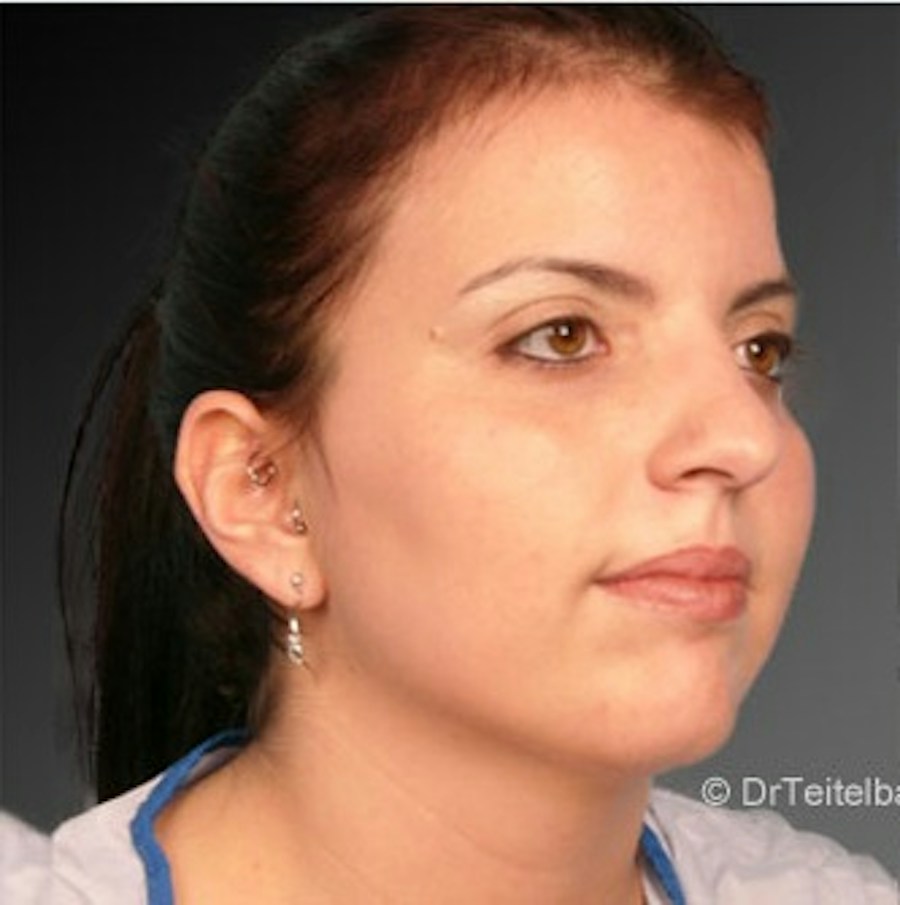 Patient 106041379 | Angle View | After | Neck Liposuction — Steven Teitelbaum MD -