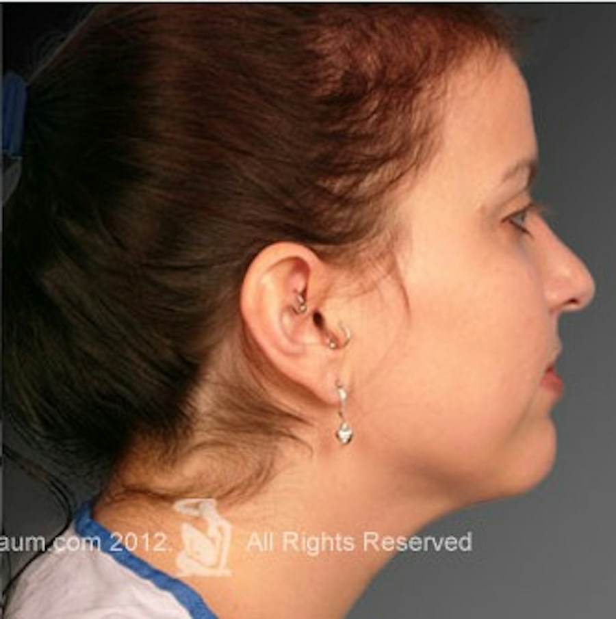 Patient 106041379 | Profile View | After | Neck Liposuction — Steven Teitelbaum MD -