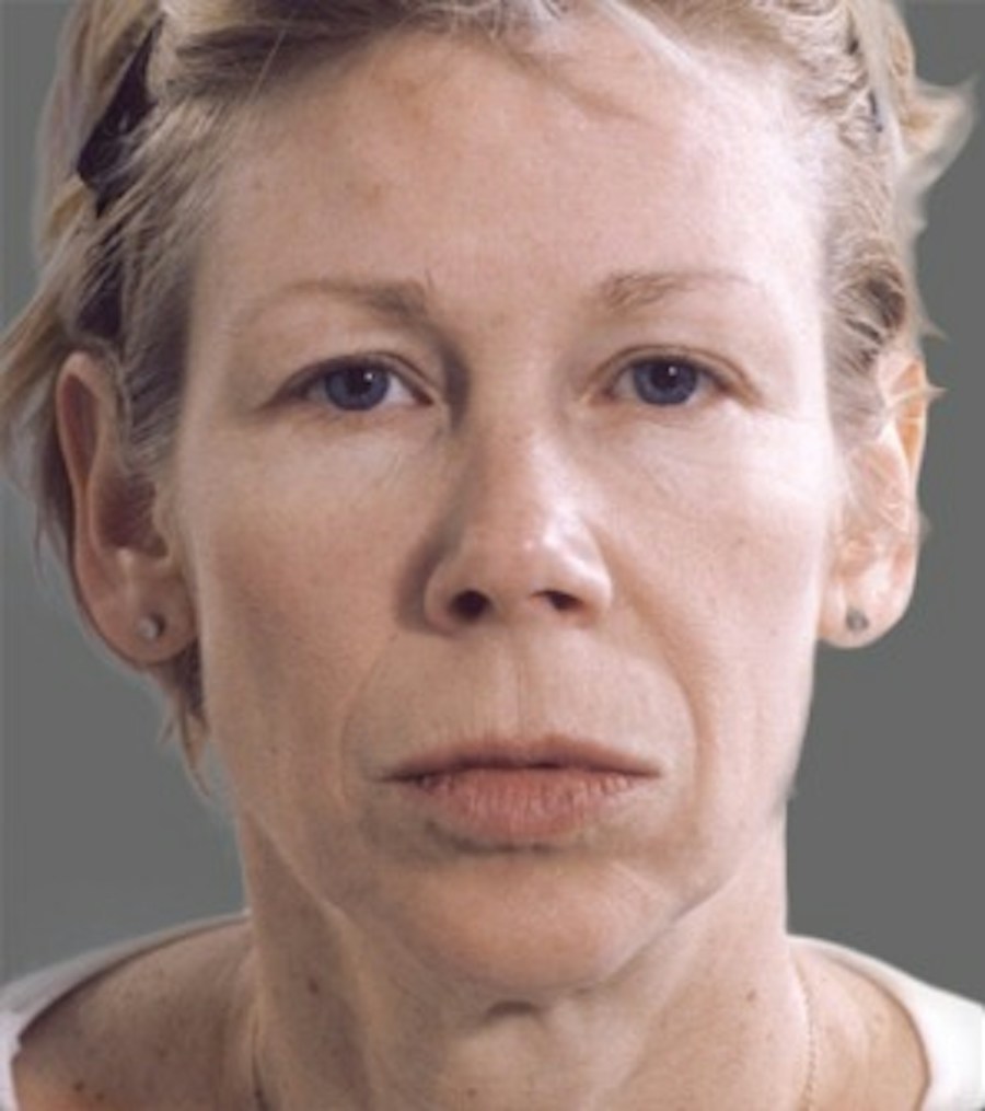 Patient 106041382 | Front View | Before | Neck Liposuction — Steven Teitelbaum MD -