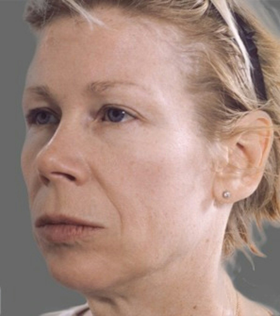 Patient 106041382 | Angle View | Before | Neck Liposuction — Steven Teitelbaum MD -
