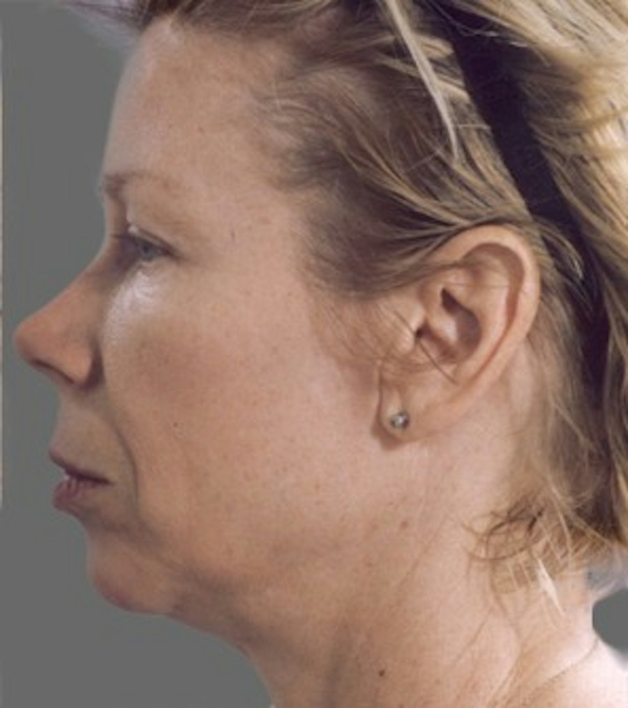 Patient 106041382 | Profile View | Before | Neck Liposuction — Steven Teitelbaum MD -