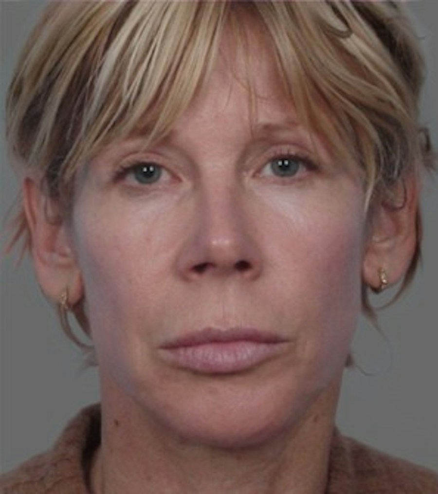 Patient 106041382 | Front View | After | Neck Liposuction — Steven Teitelbaum MD -