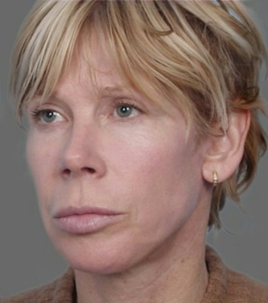 Patient 106041382 | Angle View | After | Neck Liposuction — Steven Teitelbaum MD -
