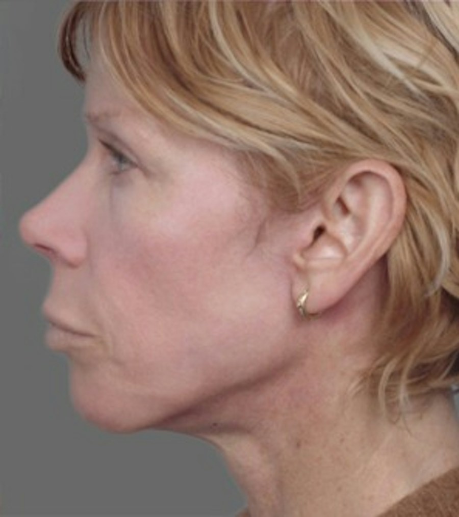 Patient 106041382 | Profile View | After | Neck Liposuction — Steven Teitelbaum MD -