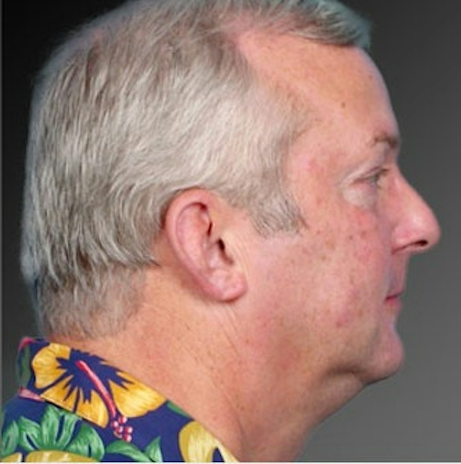 Patient 106041383 | Profile View | Before | Neck Liposuction — Steven Teitelbaum MD -