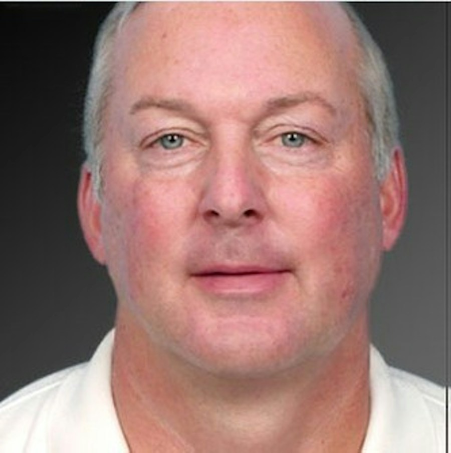 Patient 106041383 | Front View | After | Neck Liposuction — Steven Teitelbaum MD -