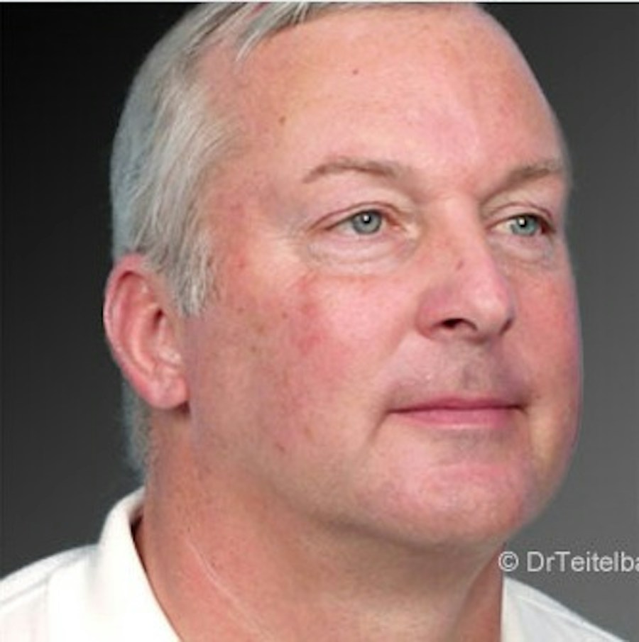 Patient 106041383 | Angle View | After | Neck Liposuction — Steven Teitelbaum MD -