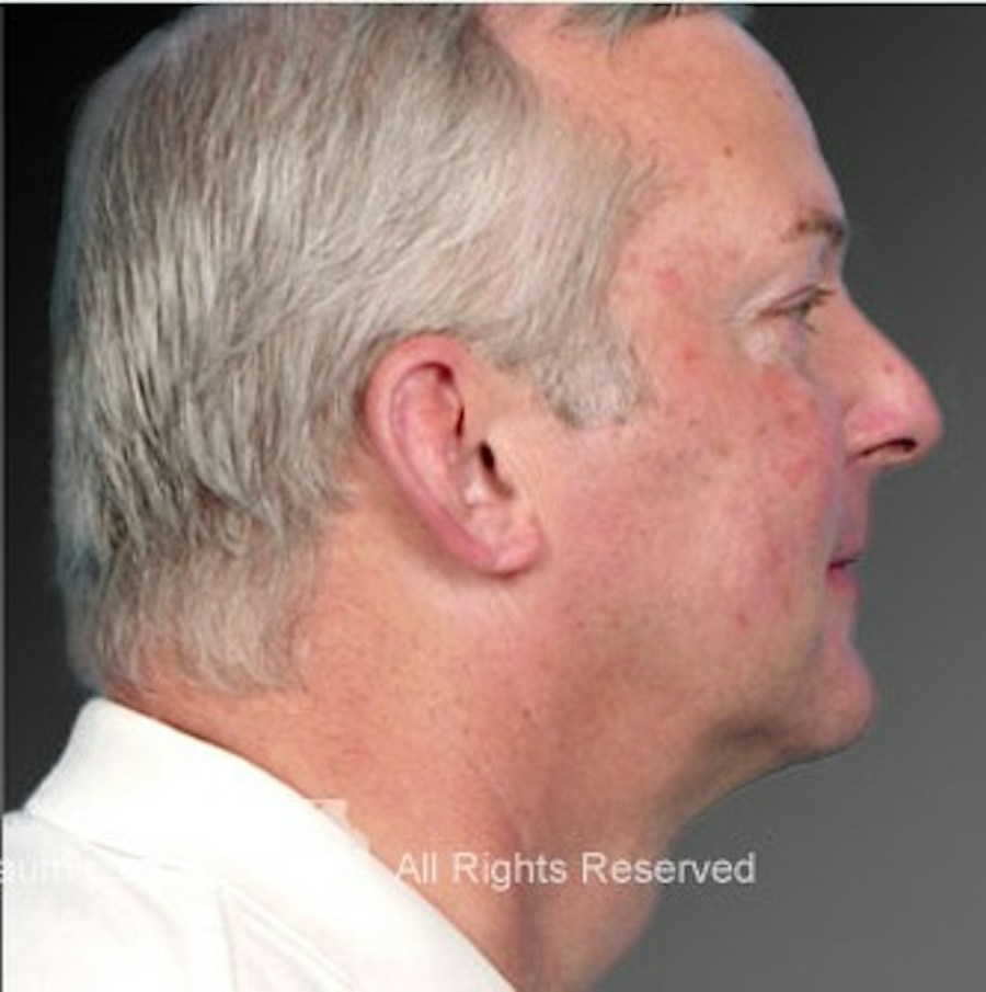 Patient 106041383 | Profile View | After | Neck Liposuction — Steven Teitelbaum MD -