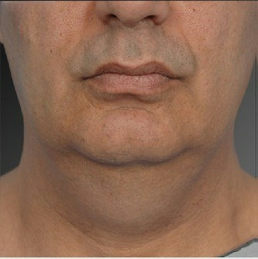 Patient 106041384 | Front View | Before | Neck Liposuction — Steven Teitelbaum MD -