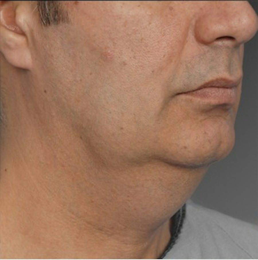 Patient 106041384 | Angle View | Before | Neck Liposuction — Steven Teitelbaum MD -