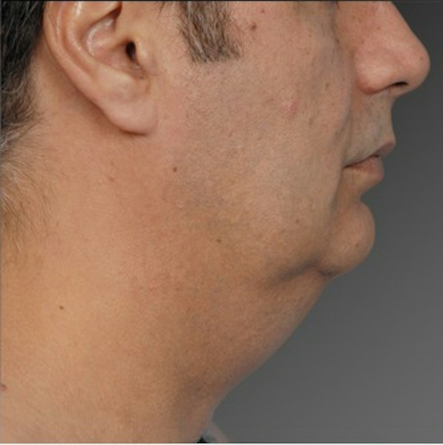 Patient 106041384 | Profile View | Before | Neck Liposuction — Steven Teitelbaum MD -