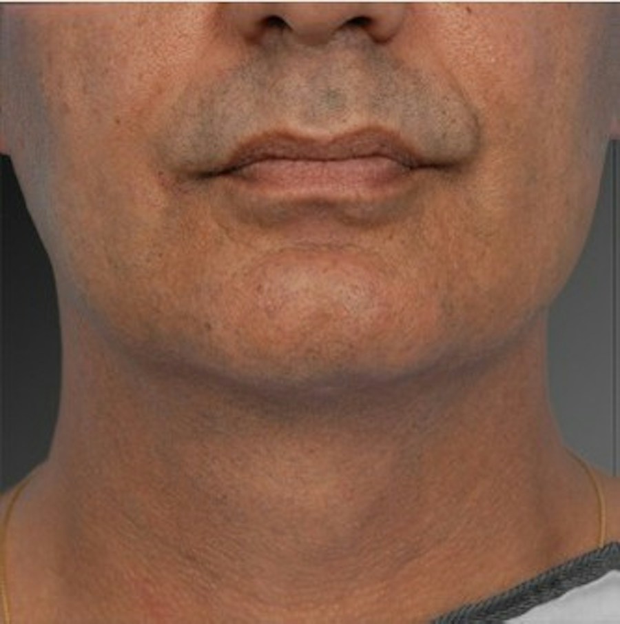 Patient 106041384 | Front View | After | Neck Liposuction — Steven Teitelbaum MD -