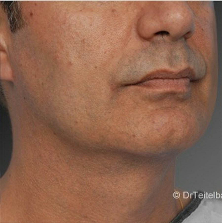 Patient 106041384 | Angle View | After | Neck Liposuction — Steven Teitelbaum MD -