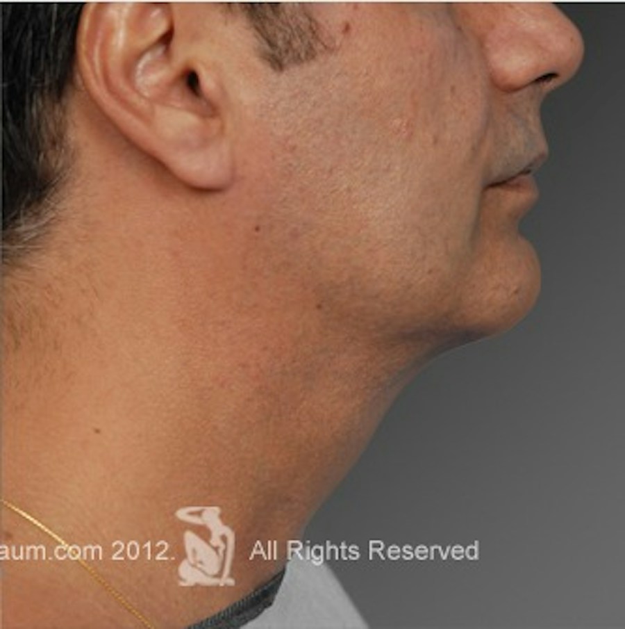 Patient 106041384 | Profile View | After | Neck Liposuction — Steven Teitelbaum MD -