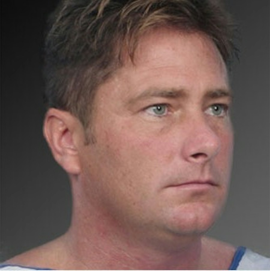 Patient 106041387 | Angle View | Before | Neck Liposuction — Steven Teitelbaum MD -