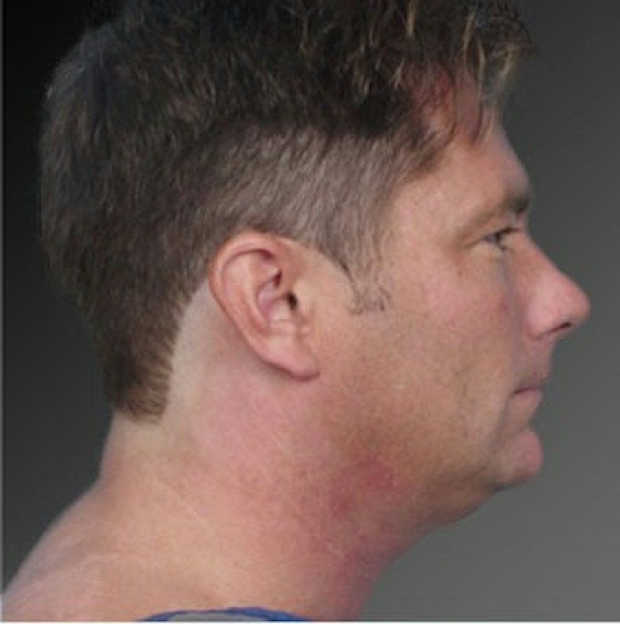 Patient 106041387 | Profile View | Before | Neck Liposuction — Steven Teitelbaum MD -