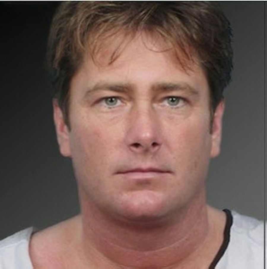 Patient 106041387 | Front View | After | Neck Liposuction — Steven Teitelbaum MD -
